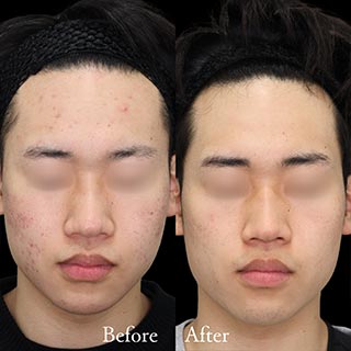 施術前後の肌の違い