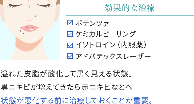 黒ニキビの効果的な治療
