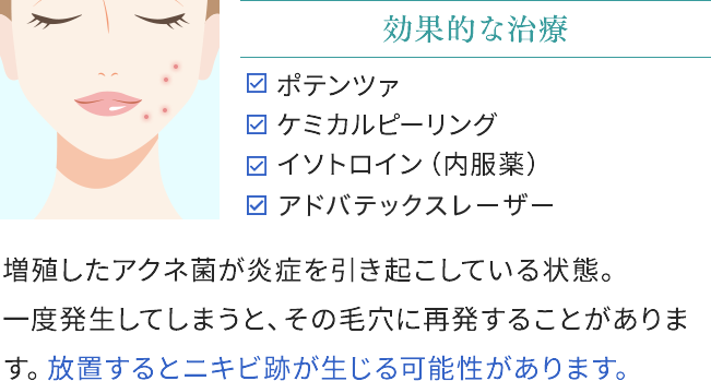 赤ニキビの効果的な治療