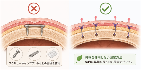 異物を使用しない固定方法