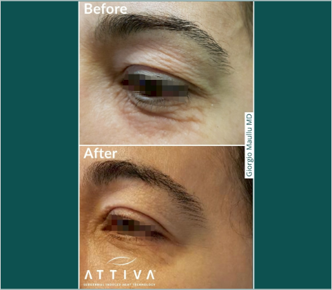 アッティバ：従来施術との違い