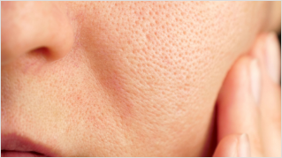 毛穴や肌のキメの改善