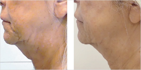 脂肪細胞の分解・減少による部分痩せ