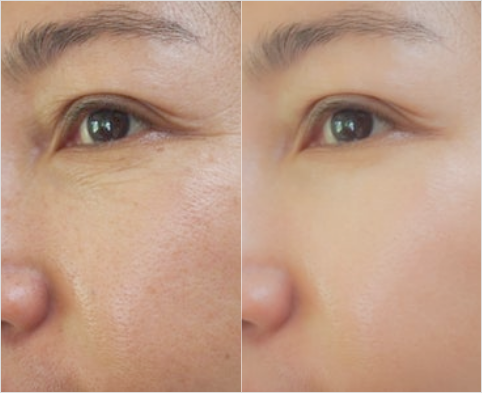 ちりめんジワ・ツヤ感低下への効果