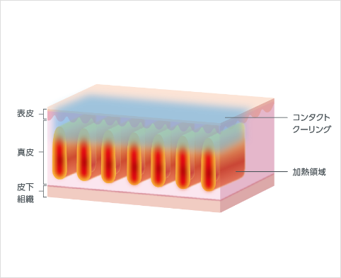コンタクトクーリングシステム「Sofcool」