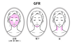 ハリ・シワ・たるみにアプローチできるウルトラセル2の施術部位イントラジェン(GFR)