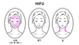 ハリ・シワ・たるみにアプローチできるウルトラセル2の施術部位ハイフ(HIFU)