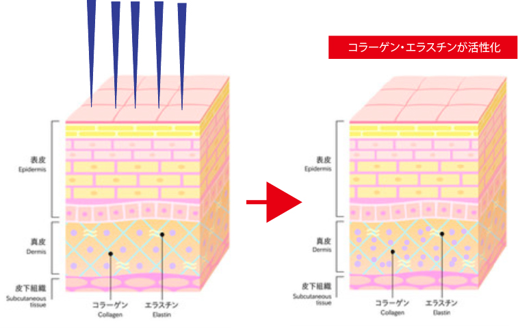 ダーマペン美肌再生治療 ダーマペン4メカニズム
