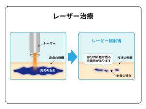 タトゥー除去:レーザー治療の仕組み