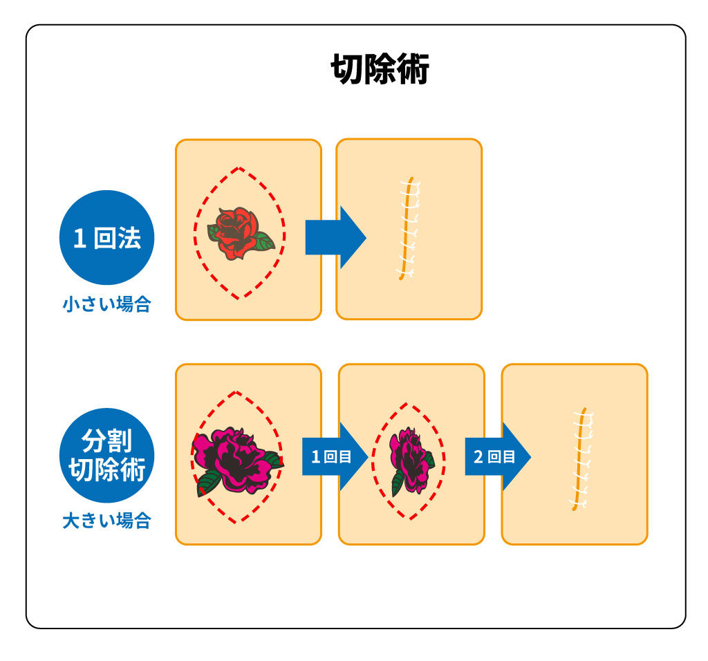 タトゥー除去:切除術の仕組み