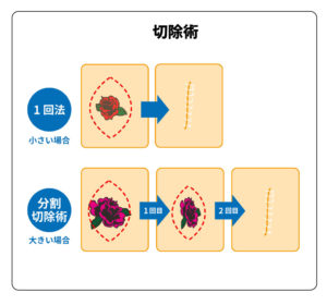 タトゥー除去方法の種類と痛み 切除術の仕組み