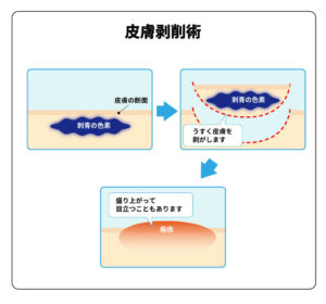 タトゥー除去法種類 削皮