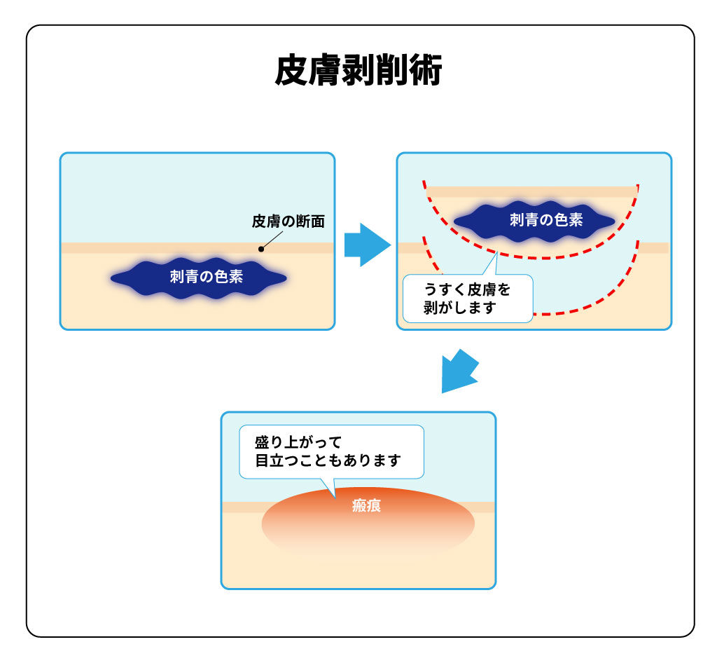 タトゥー除去:皮膚剥削術の仕組み
