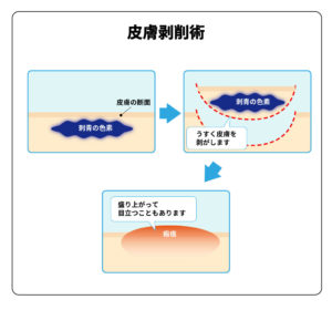 タトゥー除去方法の種類と痛み 削皮術の仕組み