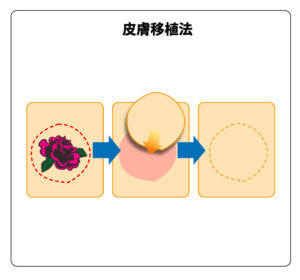 タトゥー除去:皮膚移植法の仕組み