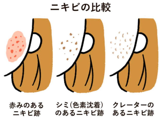 ニキビ跡の種類