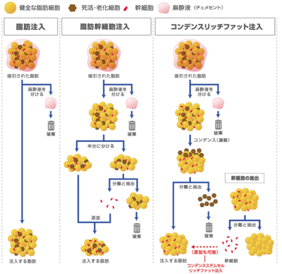 ３種類の脂肪注入の概略図
