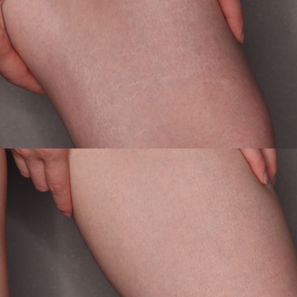 Scarless 傷跡修正 アートメイク 表参道の美容整形 美容皮膚科ならセレクトクリニック