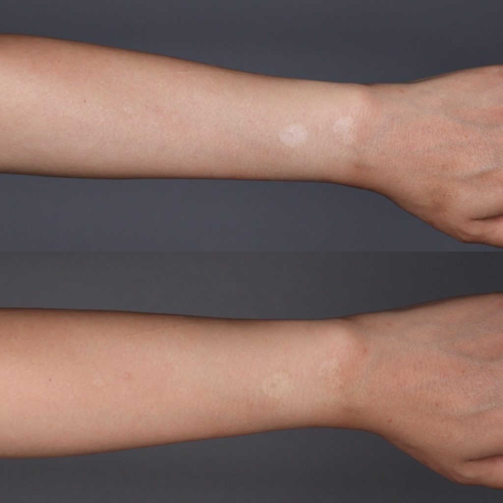 Scarless 傷跡修正 アートメイク 表参道の美容整形 美容皮膚科ならセレクトクリニック