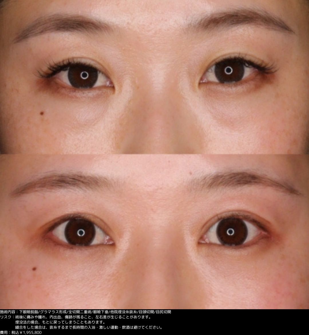 下眼瞼脱脂 グラマラスライン形成 全切開二重術 眼瞼下垂 他院埋没糸抜糸 目頭切開 目尻切開