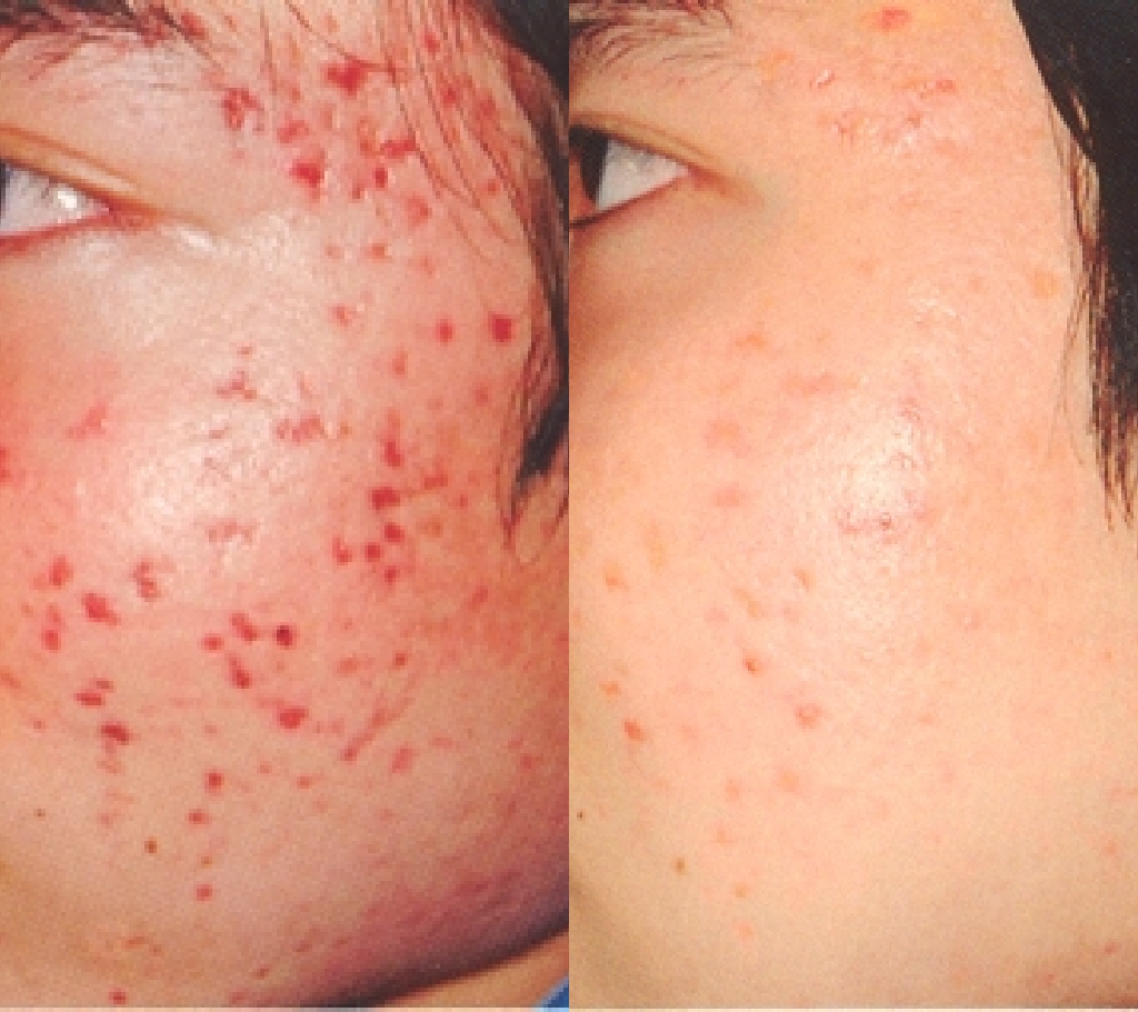 Vbeam post acne redness