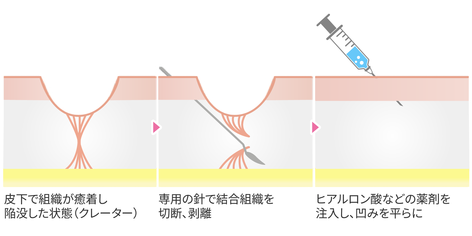 サブシジョン
