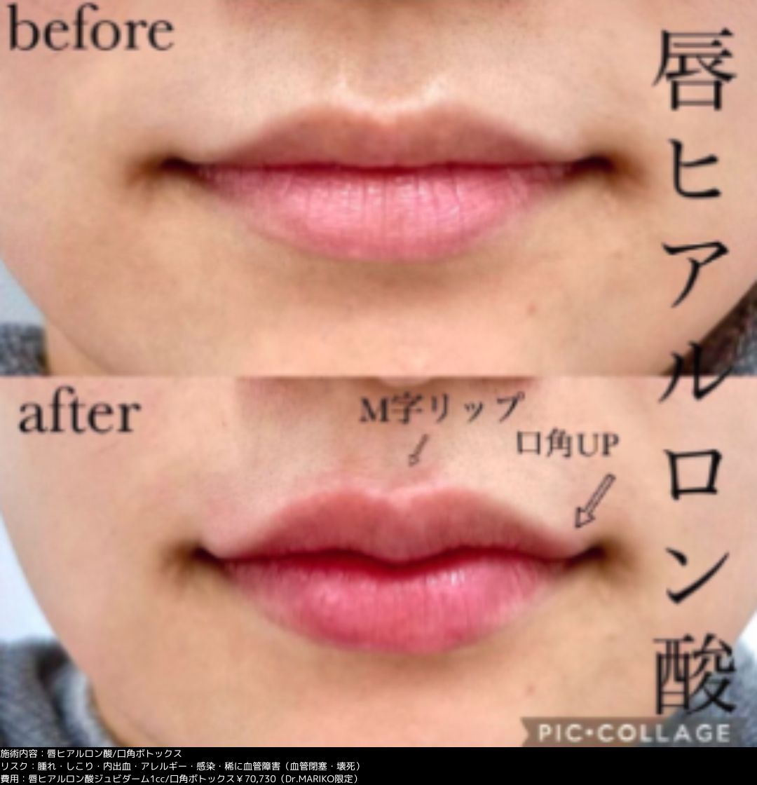 唇ヒアルロン酸 口角ボトックス