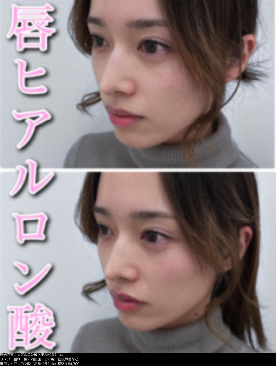 鼻整形 ヒアルロン酸注入 ボラックス 症例