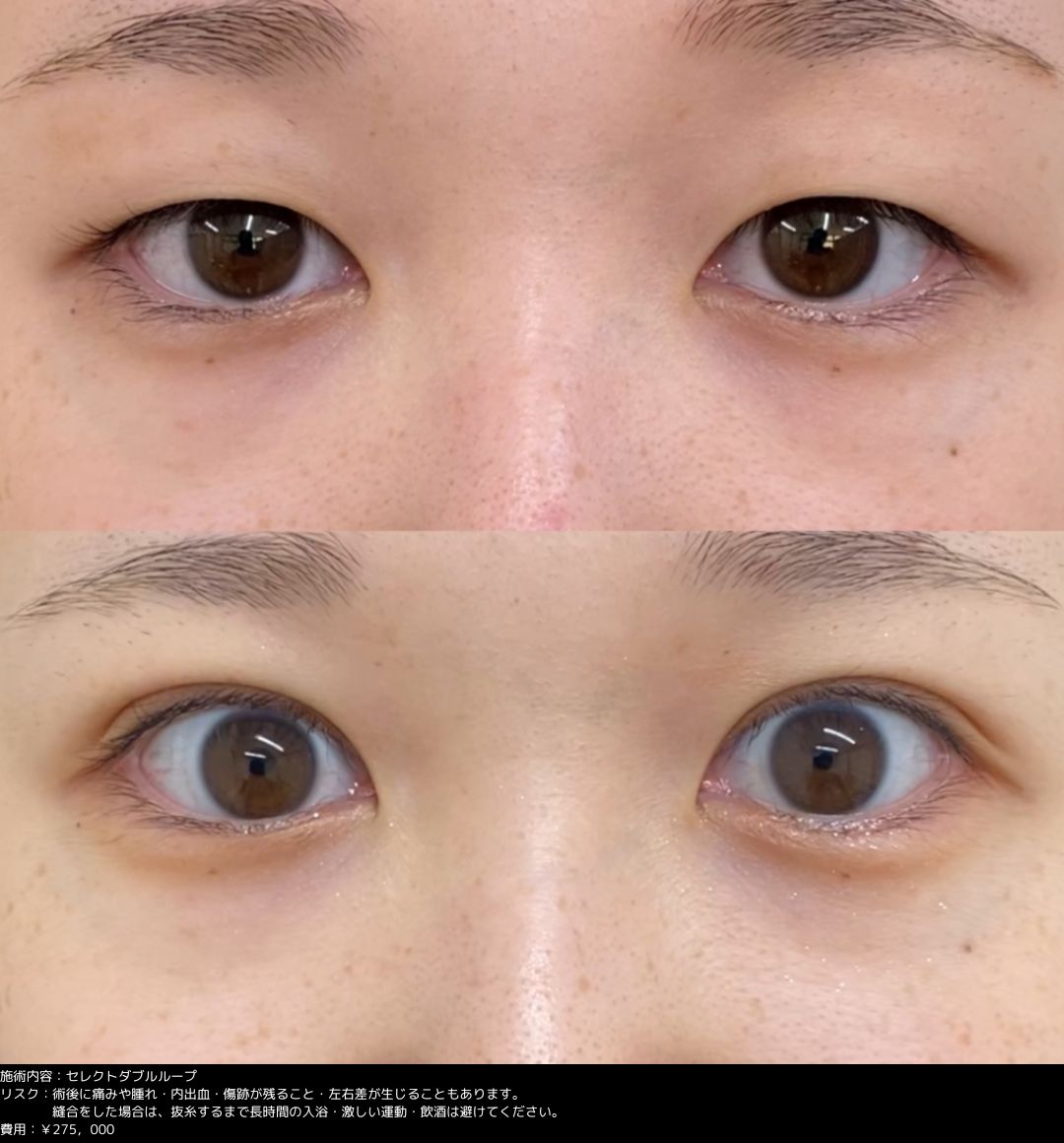 埋没法 セレクトダブルループ