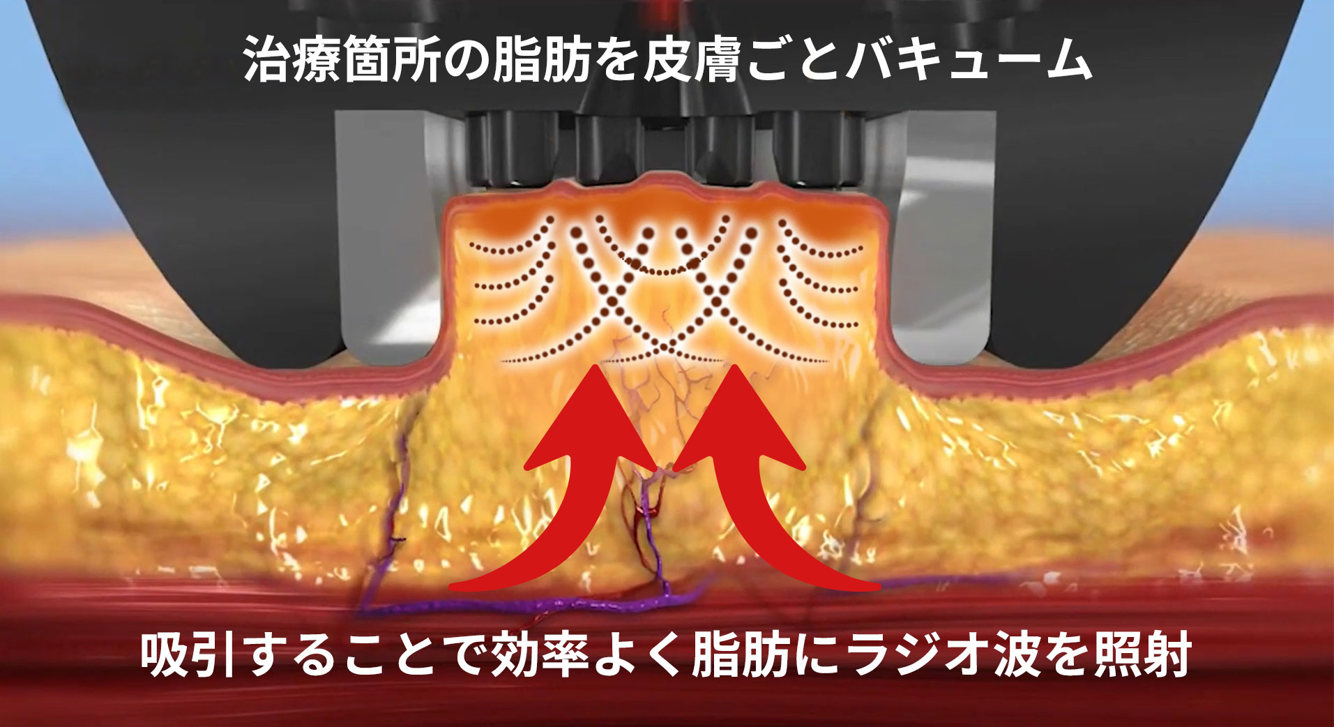 インモード 効果