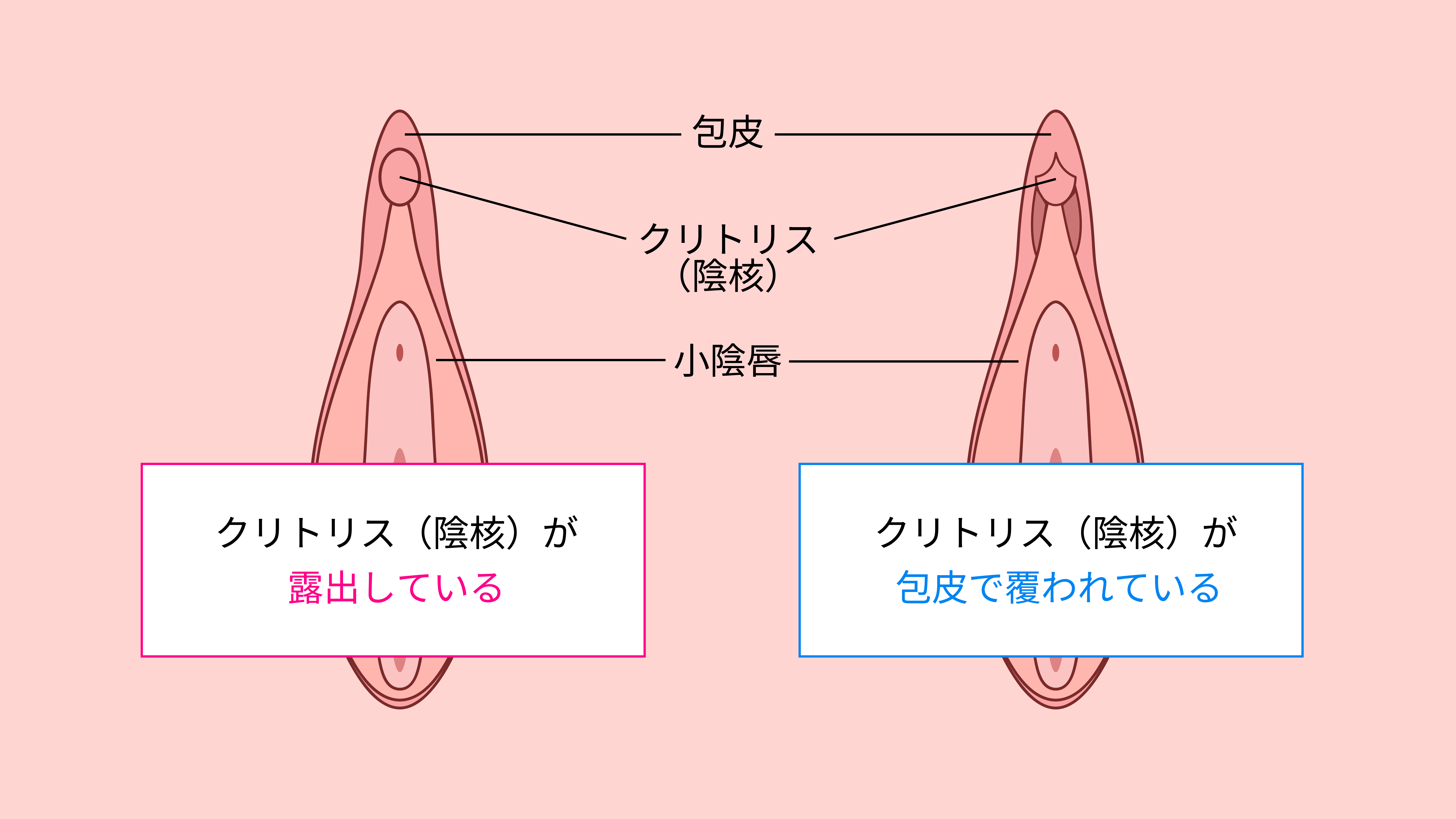 クリトリス包茎