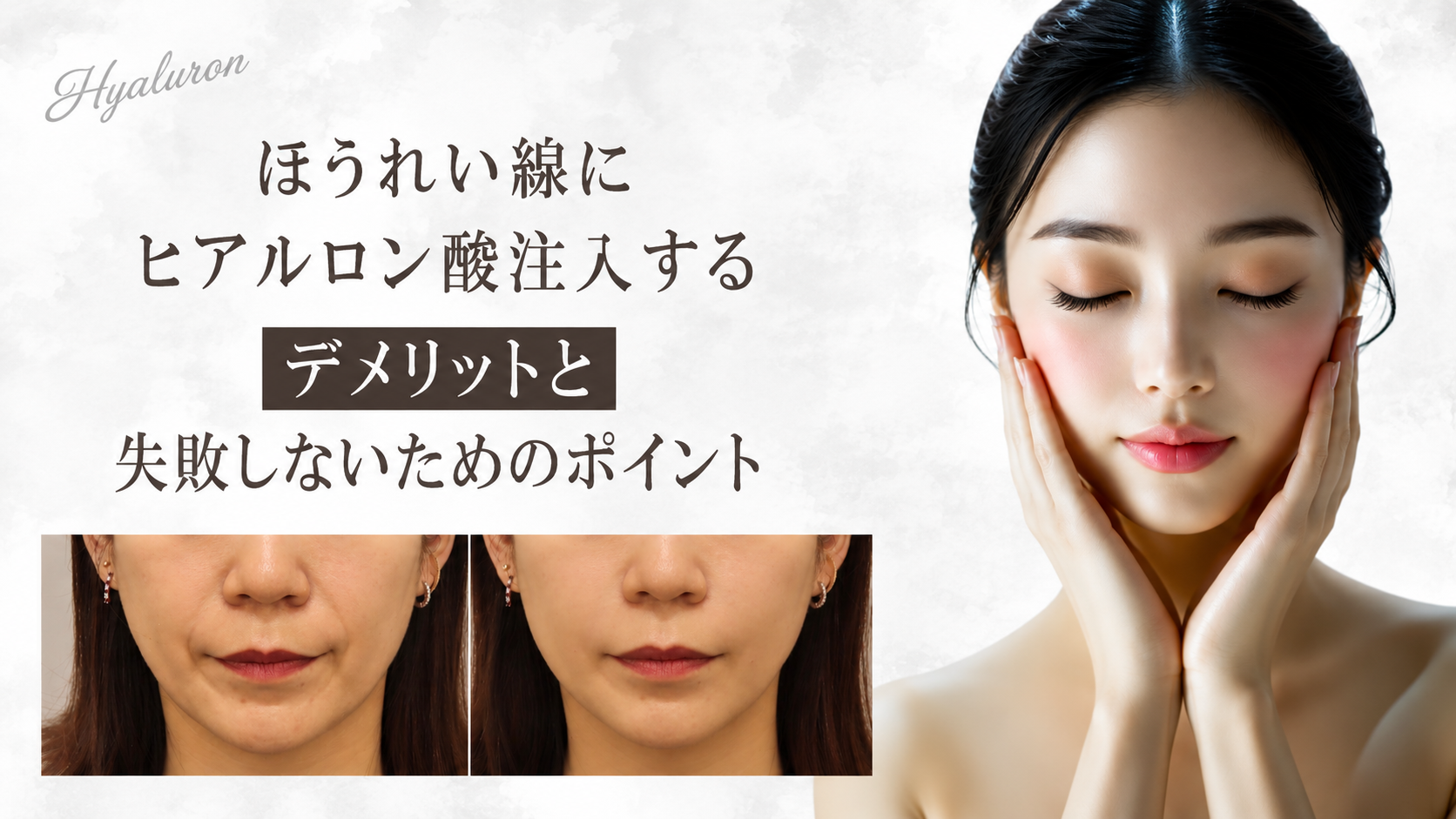 ほうれい線　ヒアルロン酸