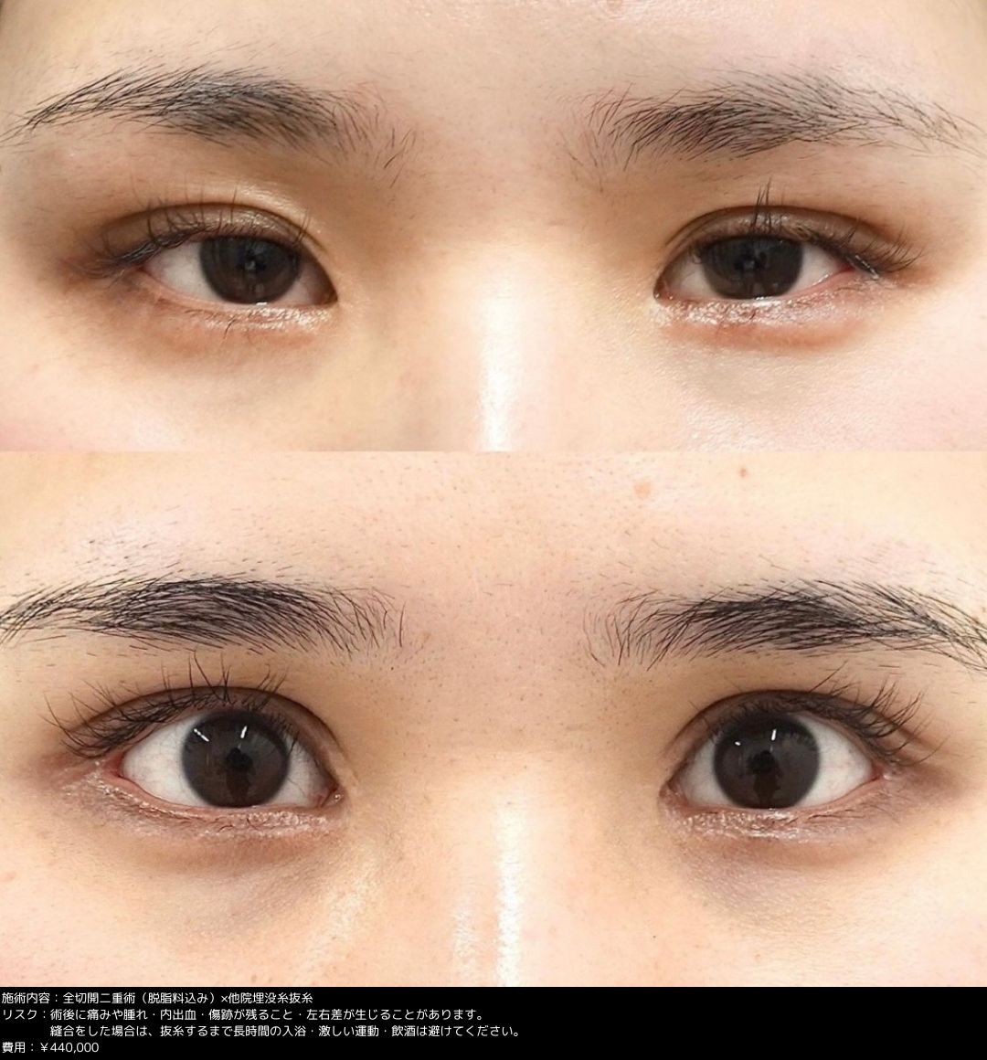 EYE eyelid surgery セレクト美容塾　眼瞼　まぶた　希少 症例掲載】眼瞼下垂を改善する方法を紹介｜ぱっちりとした目で印象を