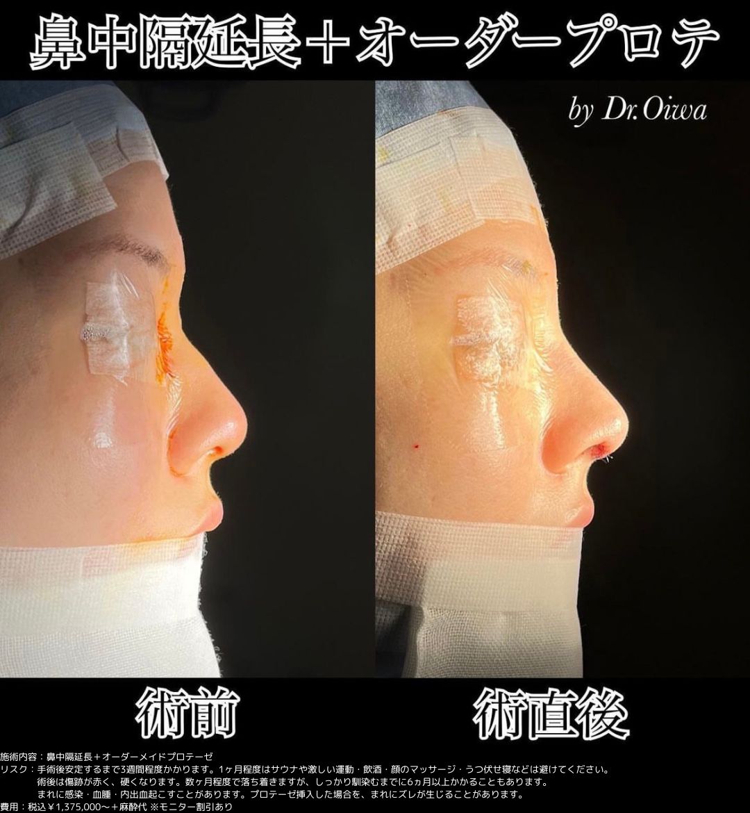 鼻整形 鼻中隔延長 プロテーゼ