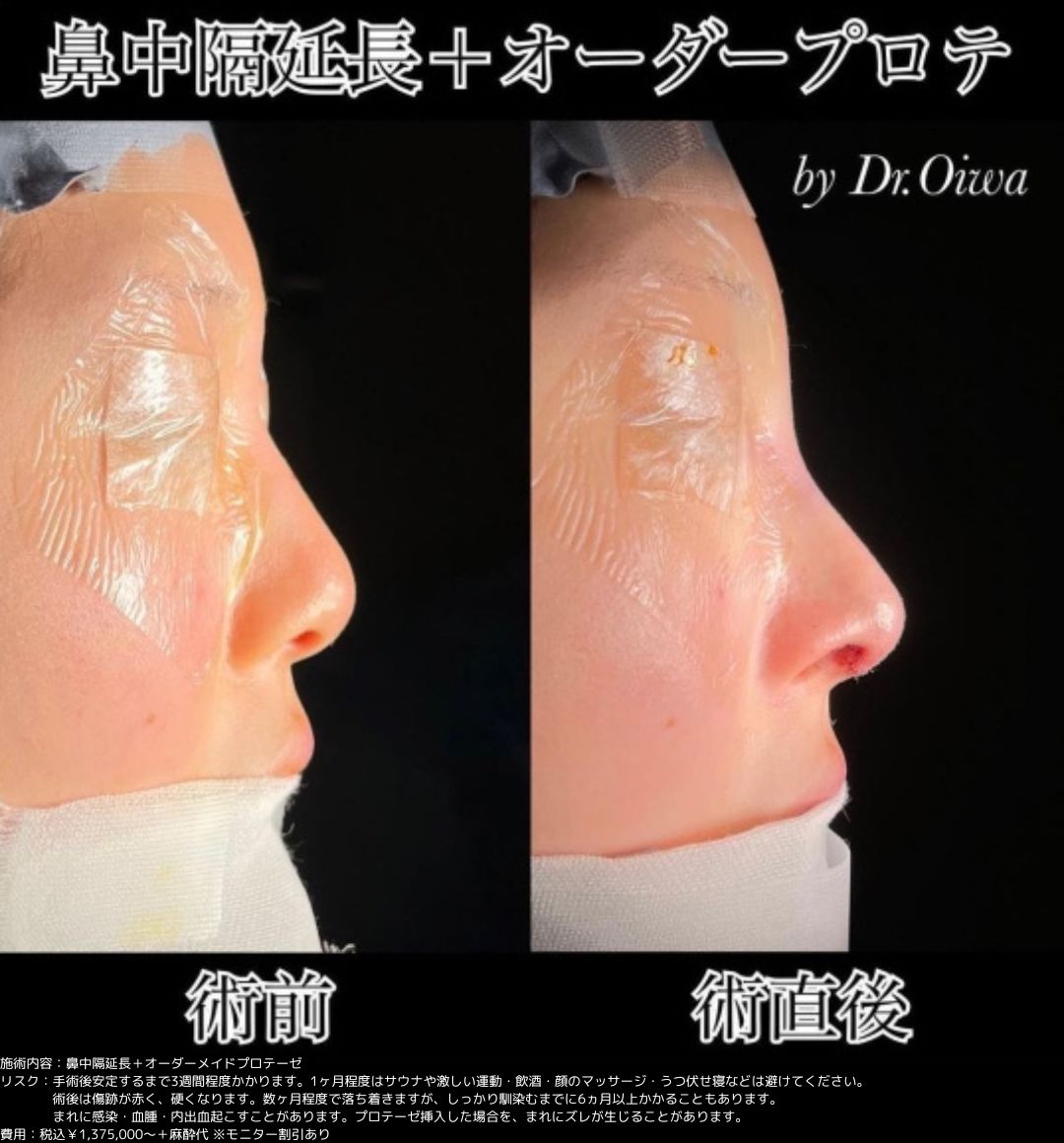 鼻整形 鼻中隔延長 プロテーゼ