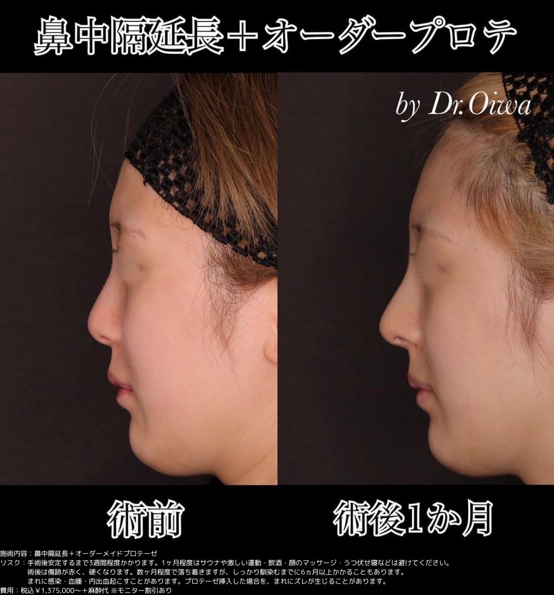 鼻整形 鼻中隔延長 プロテーゼ