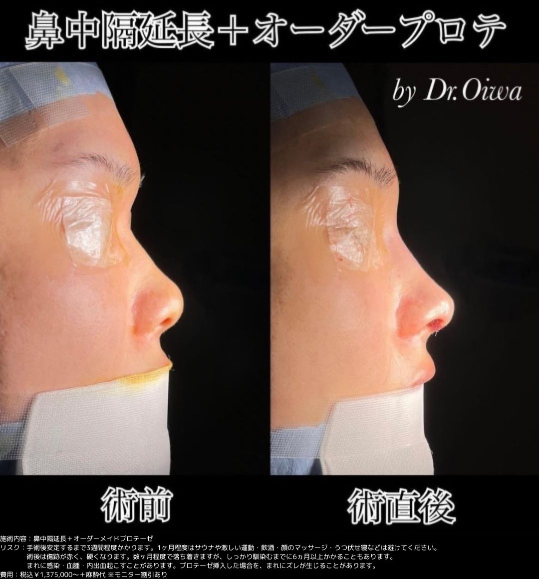 鼻整形 鼻中隔延長 プロテーゼ
