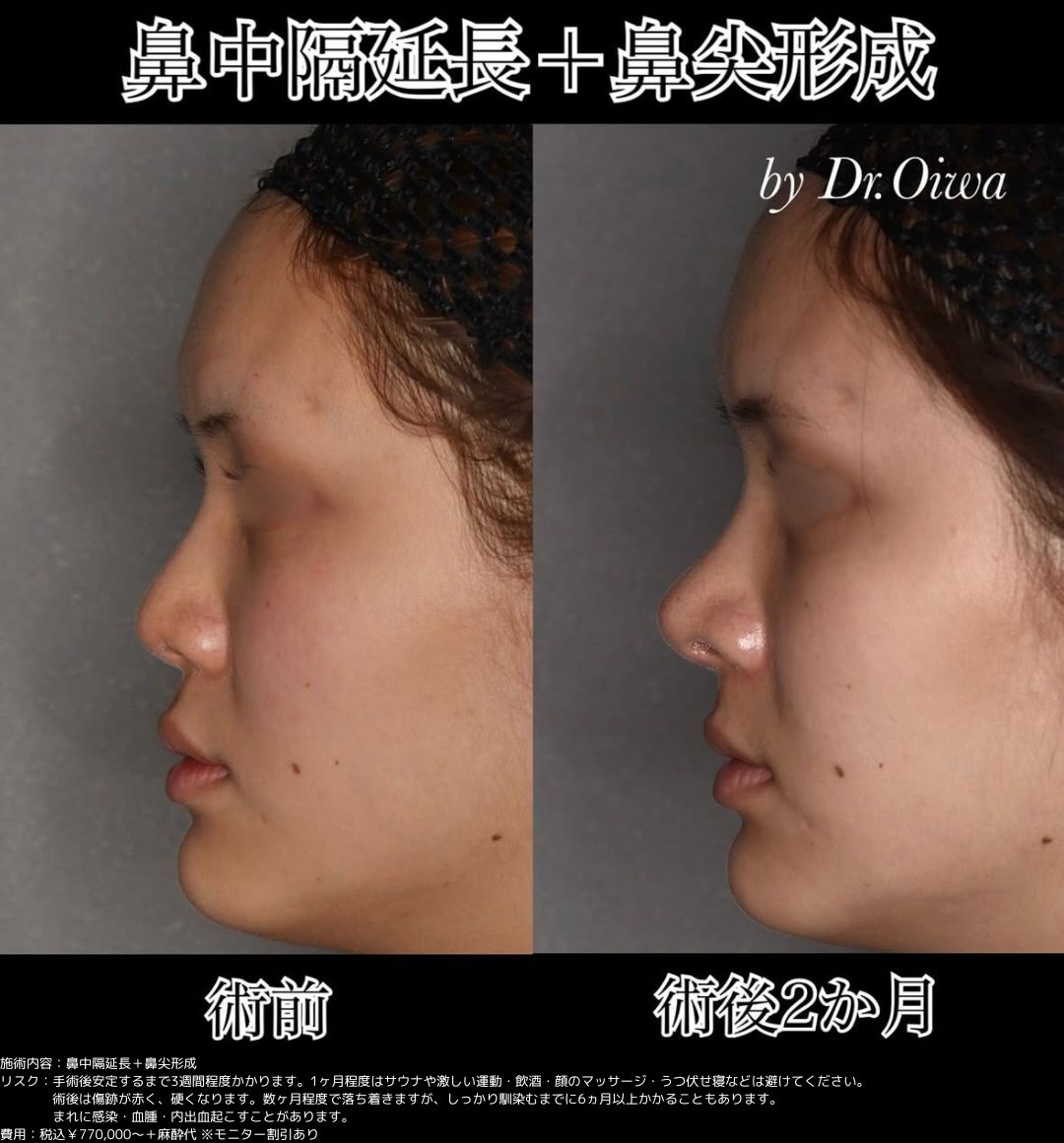 鼻中隔延長 鼻尖形成