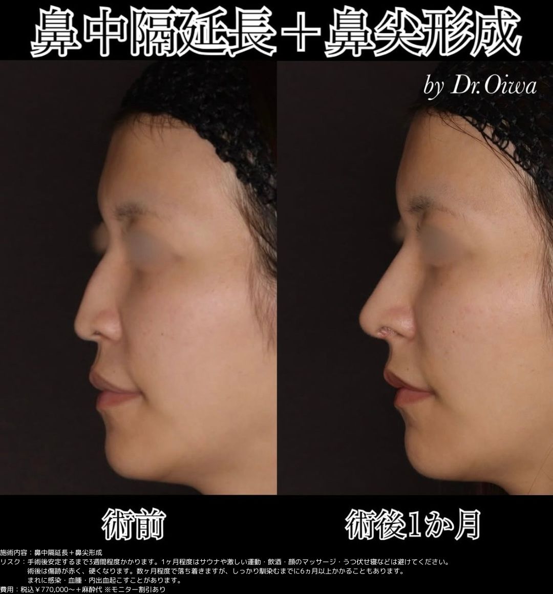 鼻中隔延長 鼻尖形成