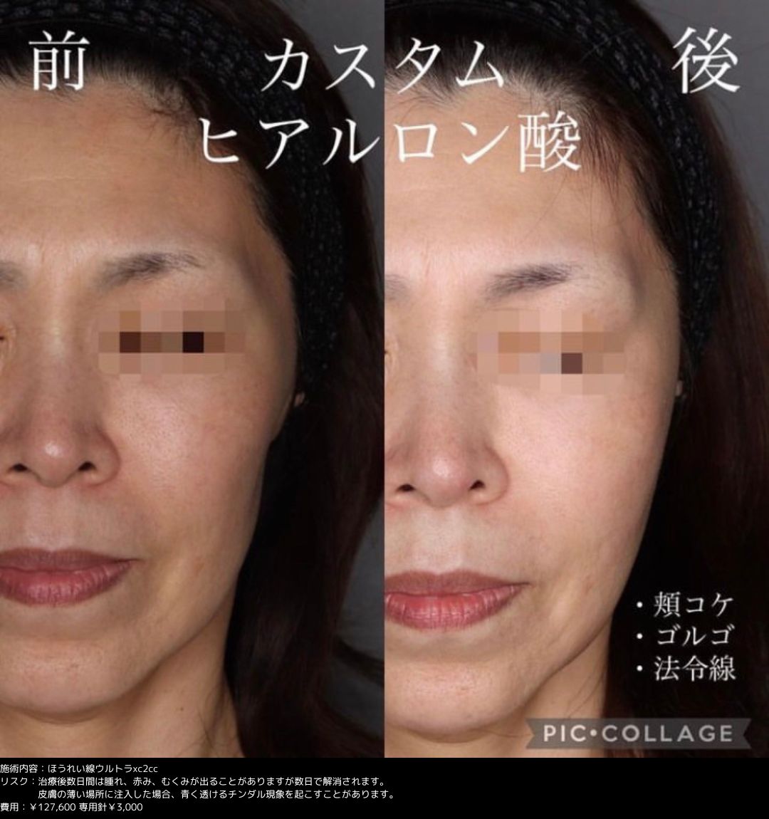 ヒアルロン酸 症例