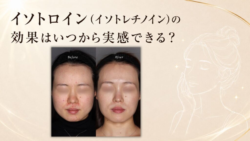 イソトロイン　イソトレチノイン　効果