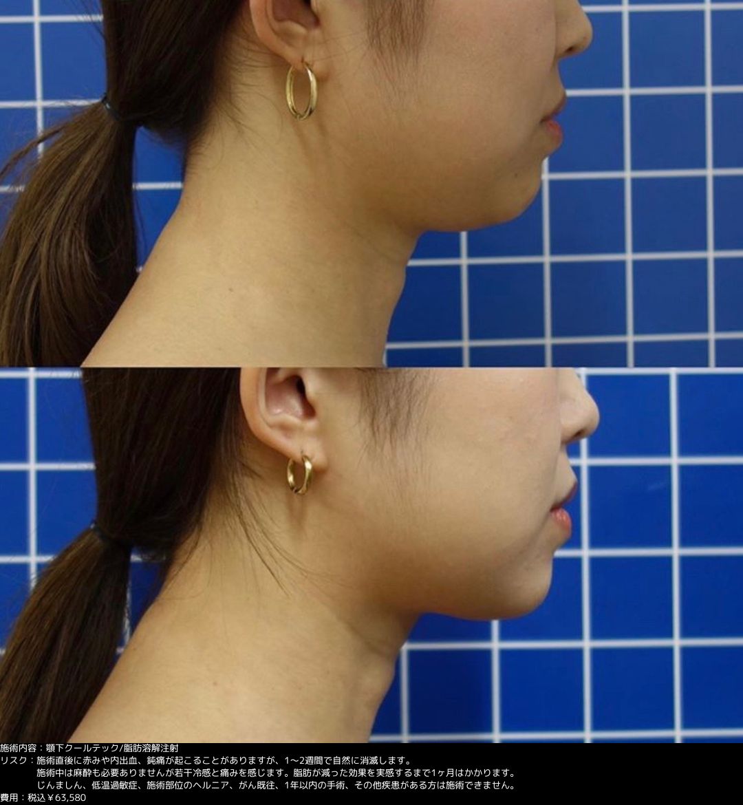 クールテック 脂肪溶解注射