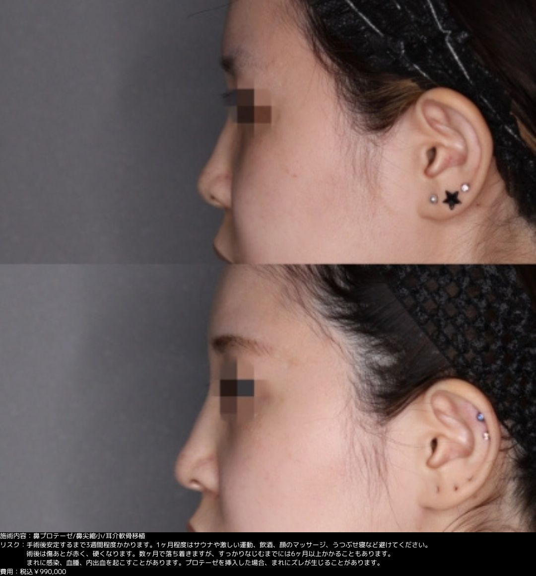 鼻プロテーゼ 鼻尖縮小 耳介軟骨移植 隆鼻術