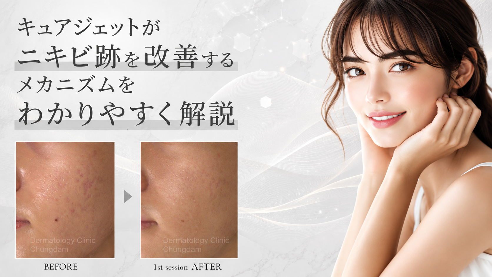 キュアジェット　ニキビ跡　改善