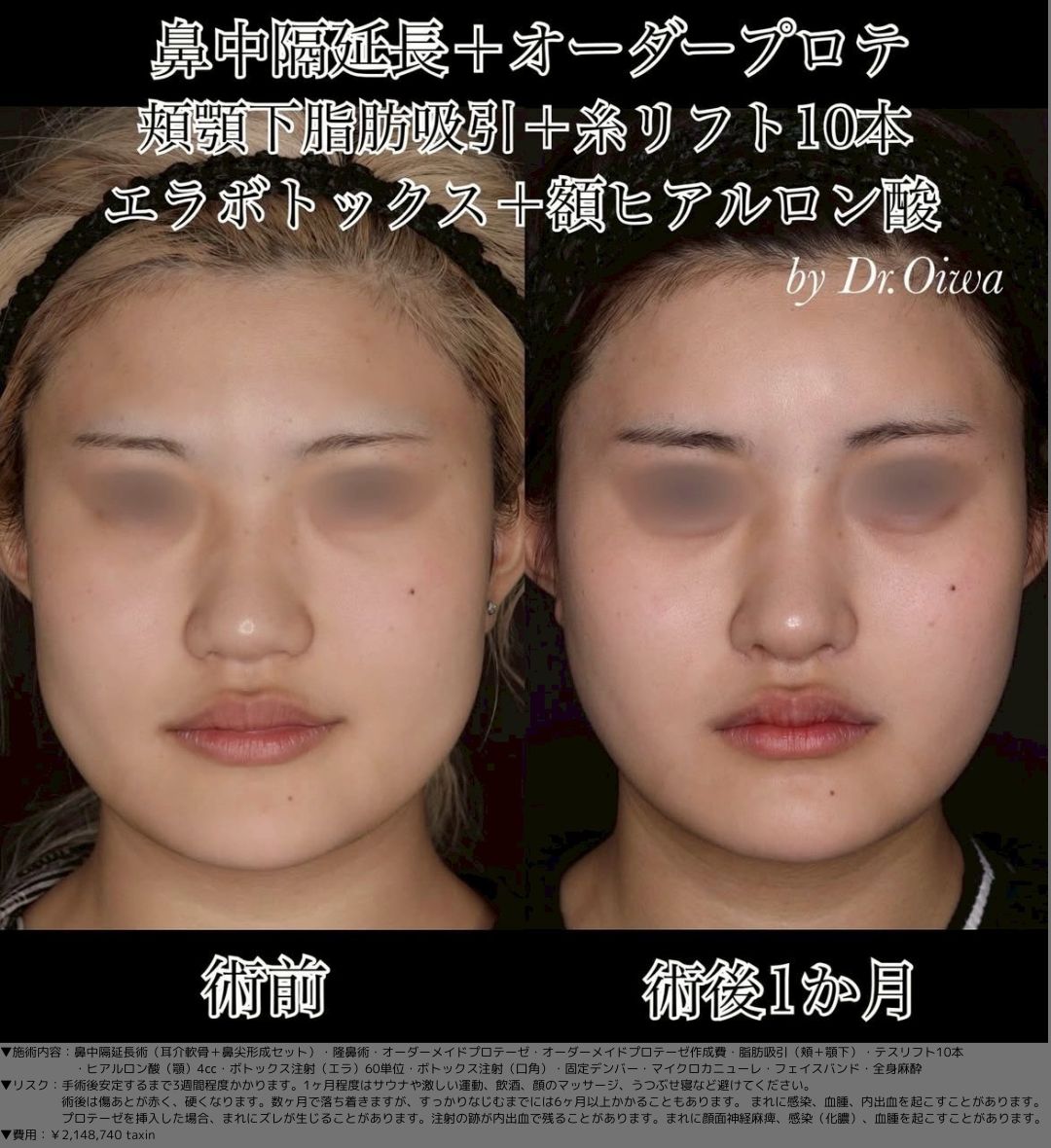 鼻中隔延長術 耳介軟骨 鼻尖形成 隆鼻術 オーダーメイドプロテーゼ 脂肪吸引 頬 顎下 テスリフト10本 ヒアルロン酸（顎）4㏄ ボトックス注射（エラ）60単位 ボトックス注射（口角） マイクロカニューレ