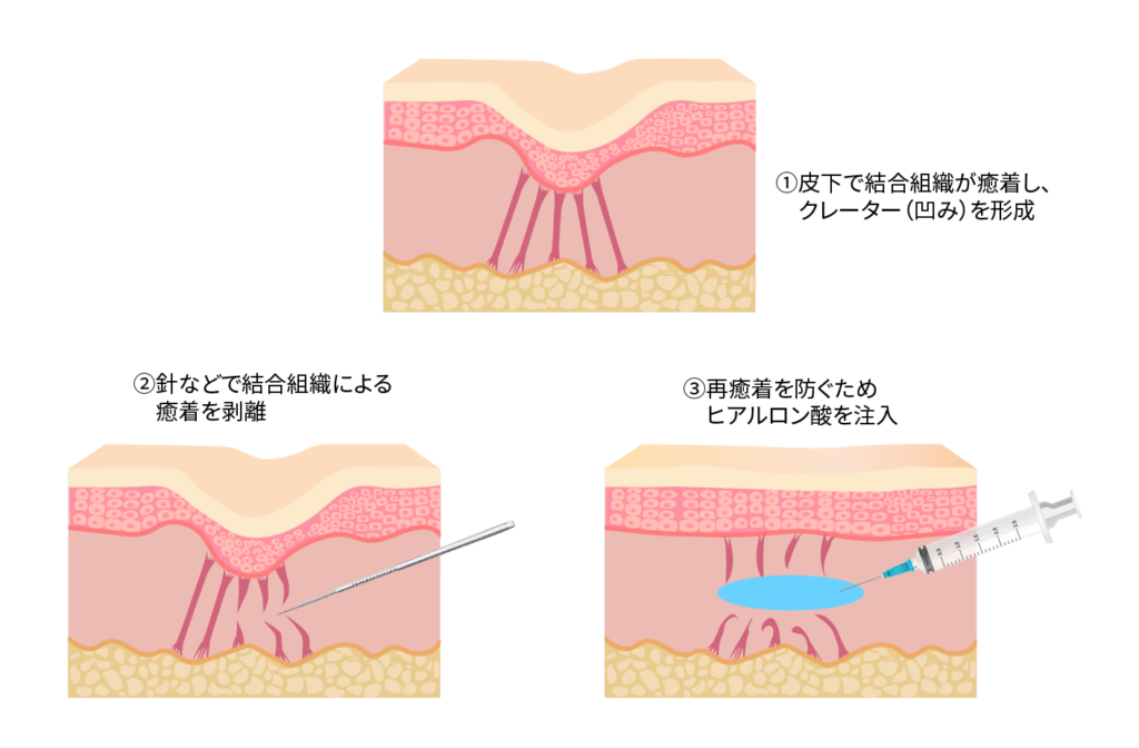 サブシジョン