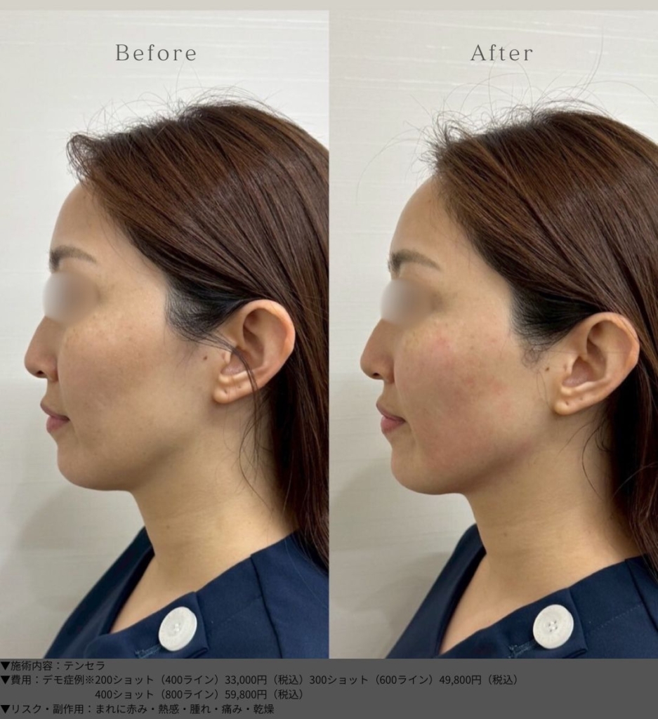 【施術内容】テンセラ