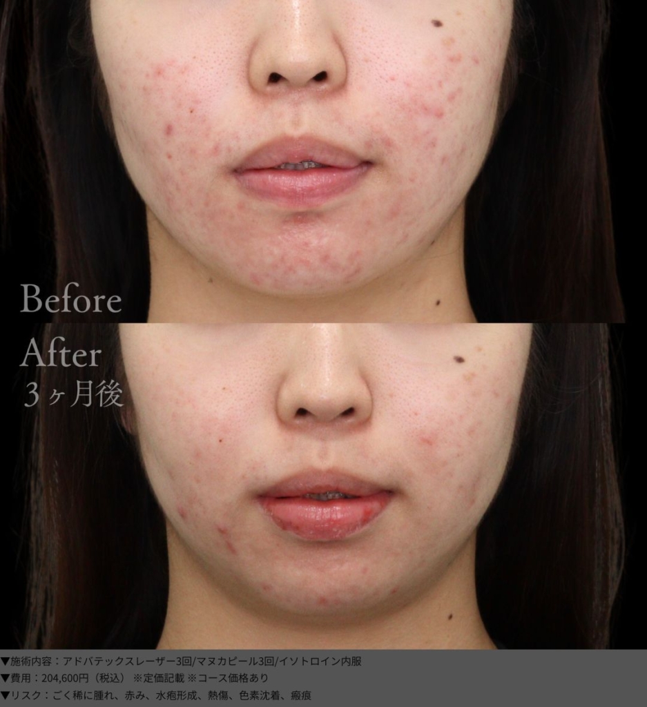 【施術内容】アドバテックスレーザー3回/マヌカピール3回/イソトロイン内服