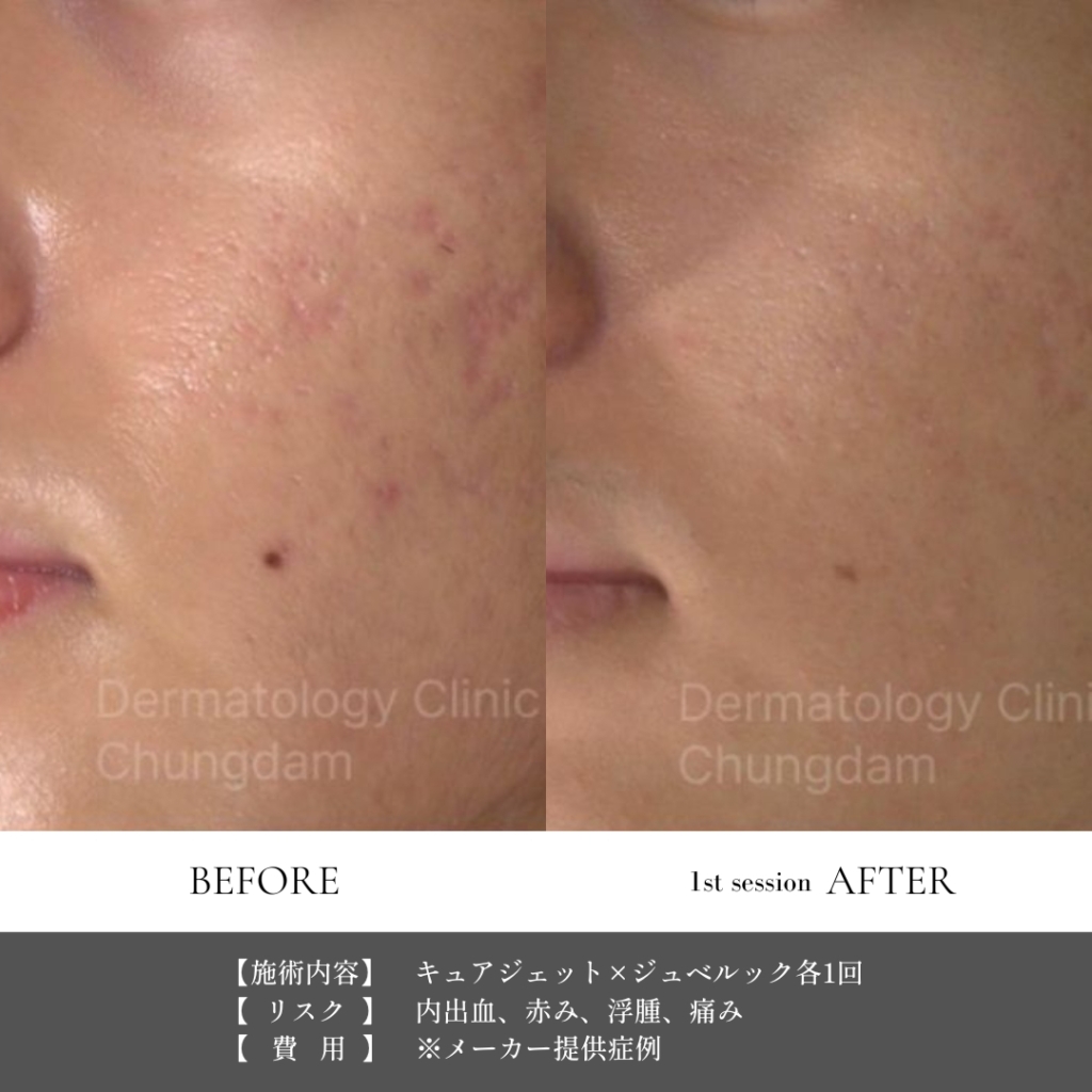 【施術内容】キュアジェット×ジュベルック各１回
