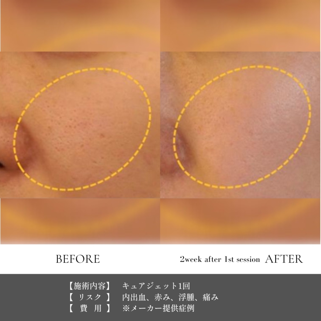 【施術内容】キュアジェット１回